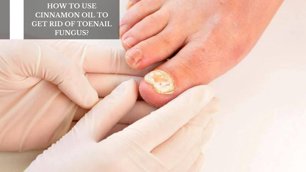 HOW TO USE CINNAMON OIL TO GET RID OF TOENAIL FUNGUS?