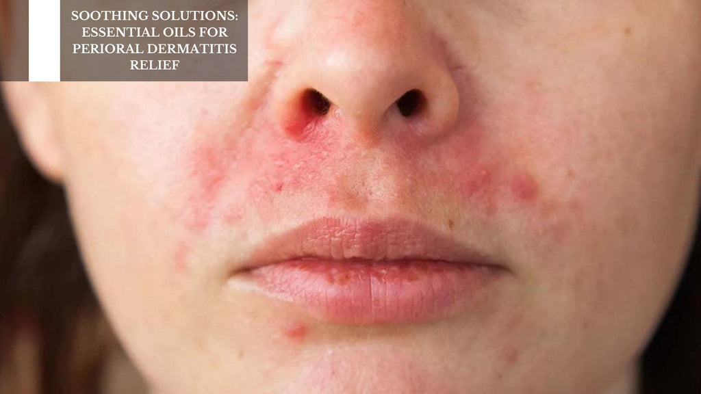 SOOTHING SOLUTIONS: ESSENTIAL OILS FOR PERIORAL DERMATITIS RELIEF