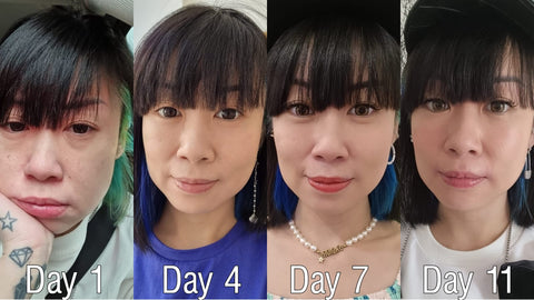 vivi cheo profhilo review before and after pictures