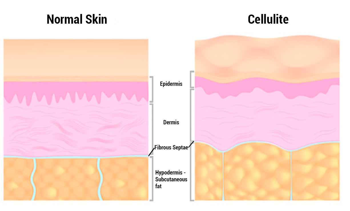 Normal skin vs skin will cellulite - Orion Red Light Therapy