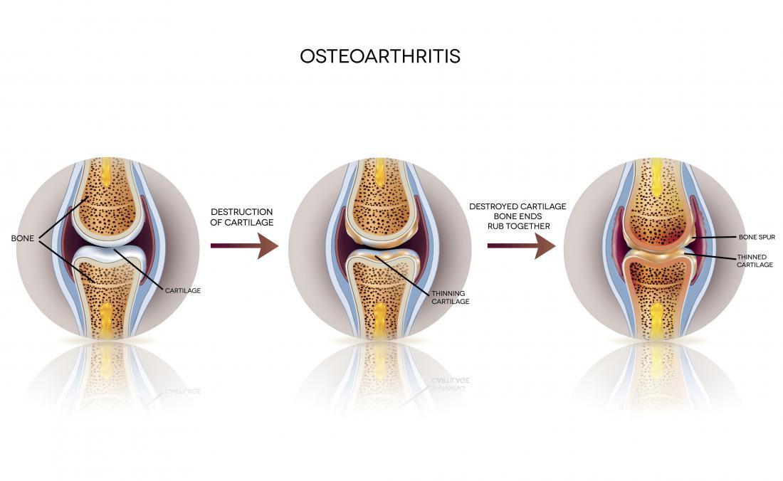 Osteoarthritis Orion Red Light Therapy