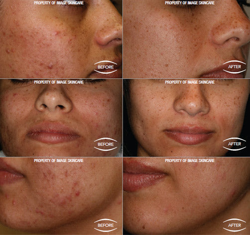 Acne skin care case studies.