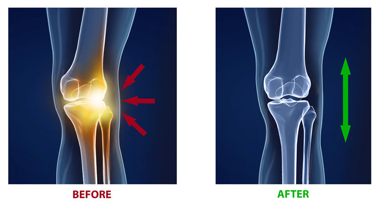 Knee Arthritis Treatment