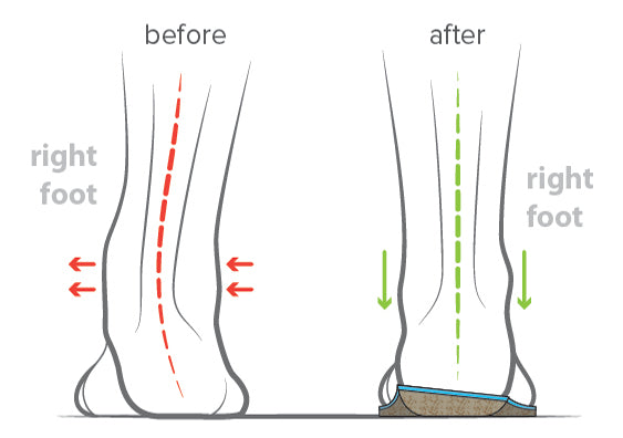 Type 1 Pronation Arch Support