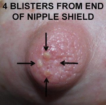 Nipple Shield Blisters. You can get blisters on the end of your nipple if your baby is sucking your nipple to the  end. Painful nipples can be helped by an open ended nipple shields. Blisters on nipples can be helped by back to mom shields