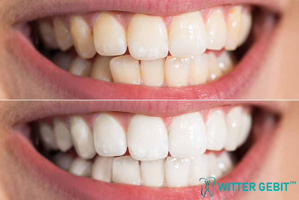 Kelder comfort Hoofdkwartier Veilig Wittere Tanden Krijgen | Witter Gebit™ Tandenbleekset