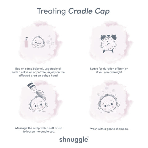 Cradle cap treatment infographic