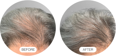 Before and after images of hair growth