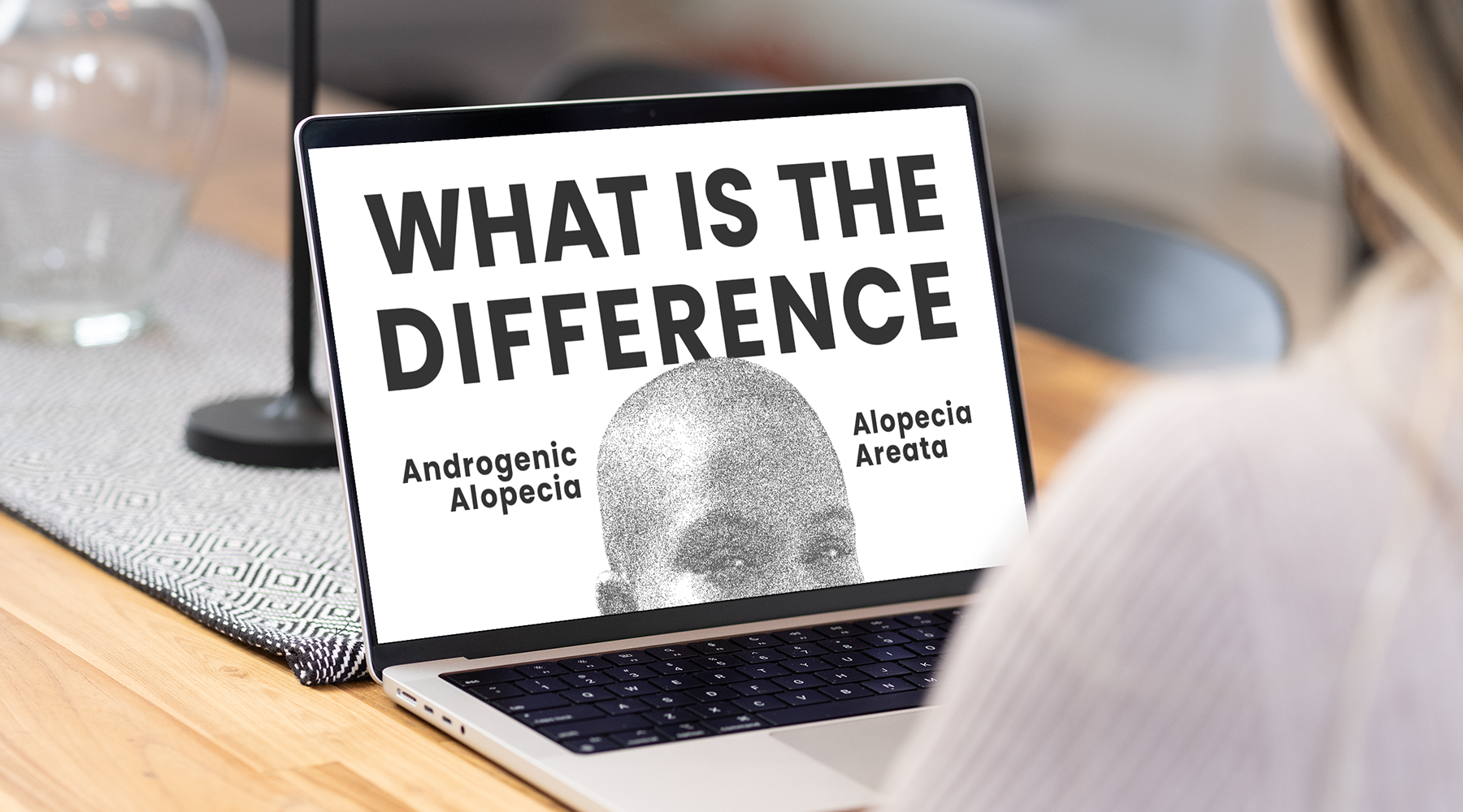 androgenic alopecia vs alopecia areata