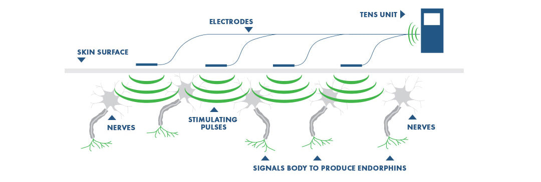 How a Tens Unit Work?
