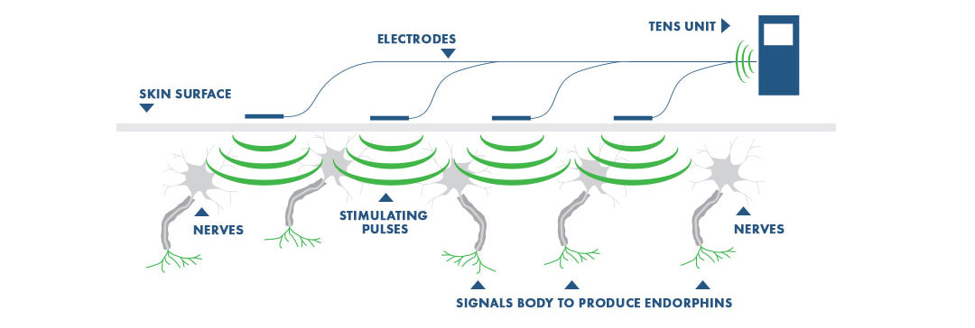 Using a TENS Machine for Labor Pain: Is It For You?