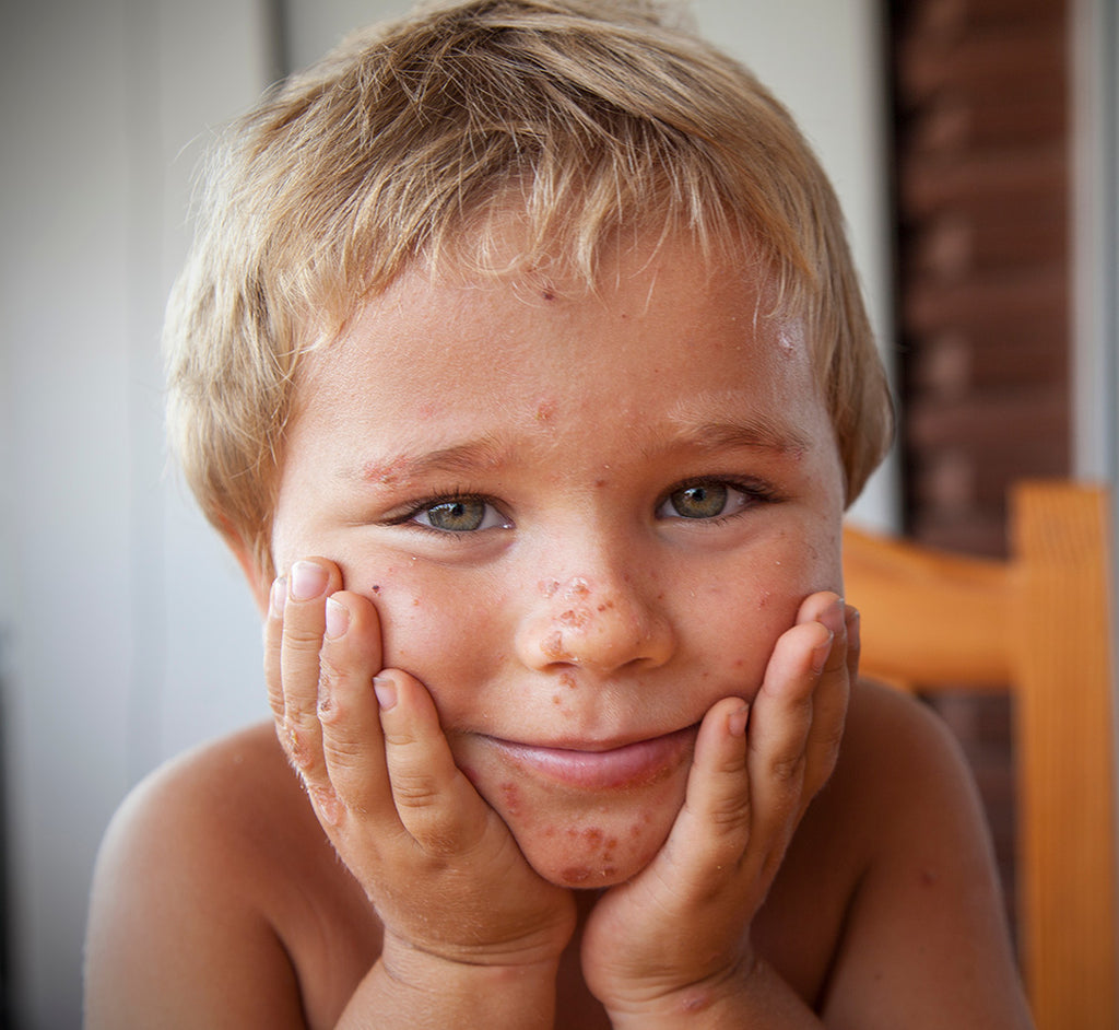 Evolution De L Eczema Atopique Chez L Enfant