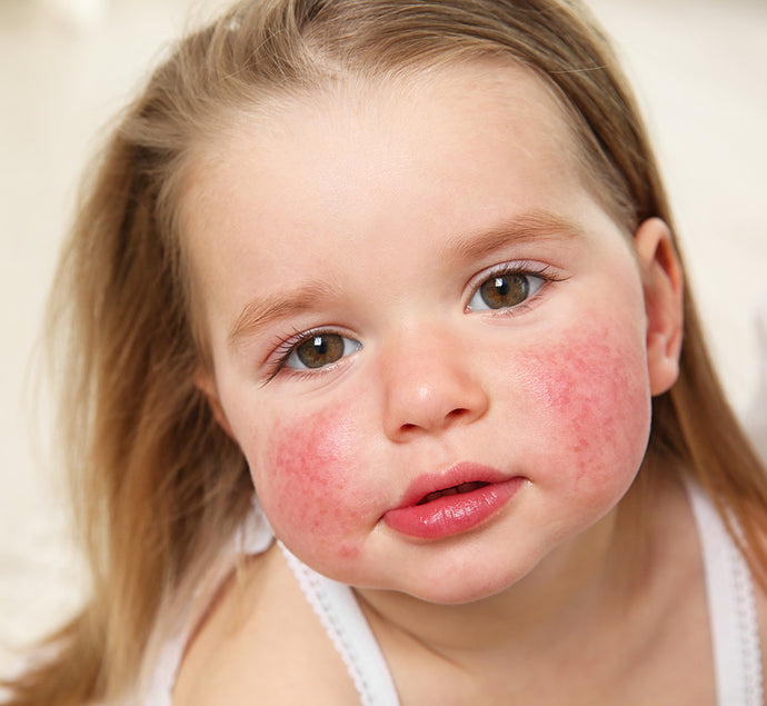 Bebe Dort Mal A Cause De L Eczema Atopique Que Faire