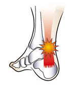 Achilles Tendinitis Pain