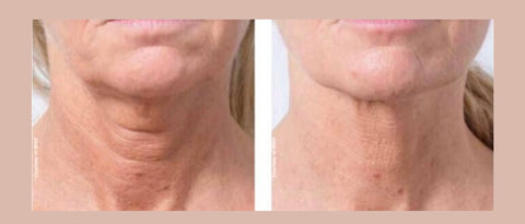 Profhilo skin boosting injections for plumping and sagging