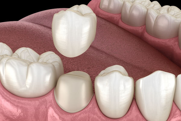 dental crowns respresentation