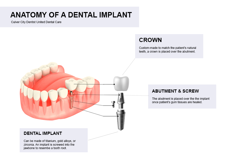 Parts of a Dental Implant
