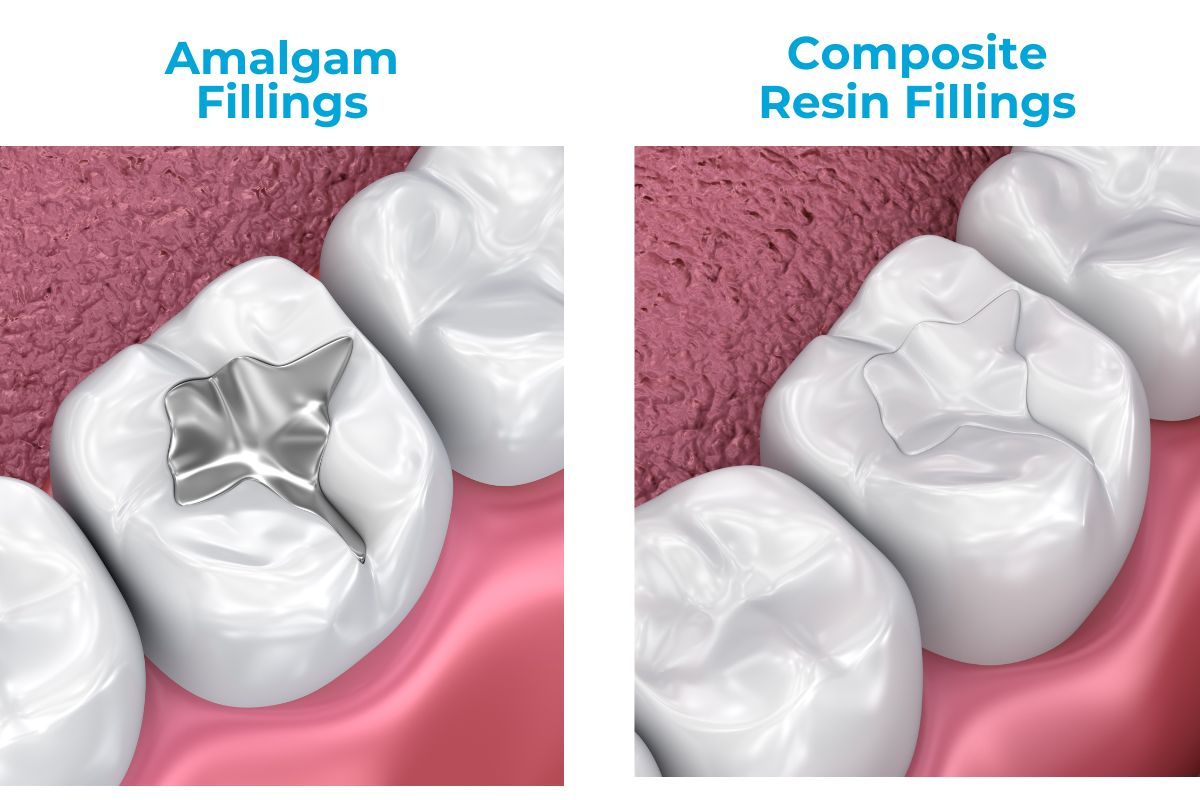 Comparison of dental fillings: Amalgam filling on the left and composite resin filling on the right.
