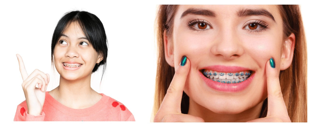 A fair-skinned girl on the left with pink-colored braces, girl on right a light-skinned girl on the right with blue-colored braces
