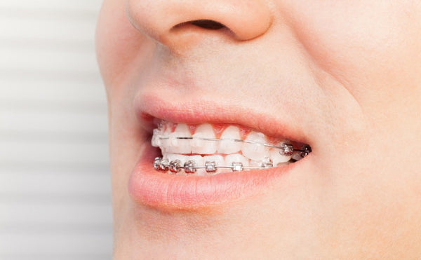 Patients can get ceramic braces on their top teeth and metal braces on the bottom teeth, which aren’t that visible