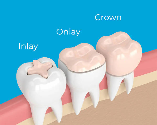 inlay onlay crown difference