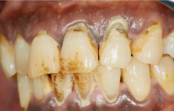 Close-up image of teeth and gums affected by periodontitis