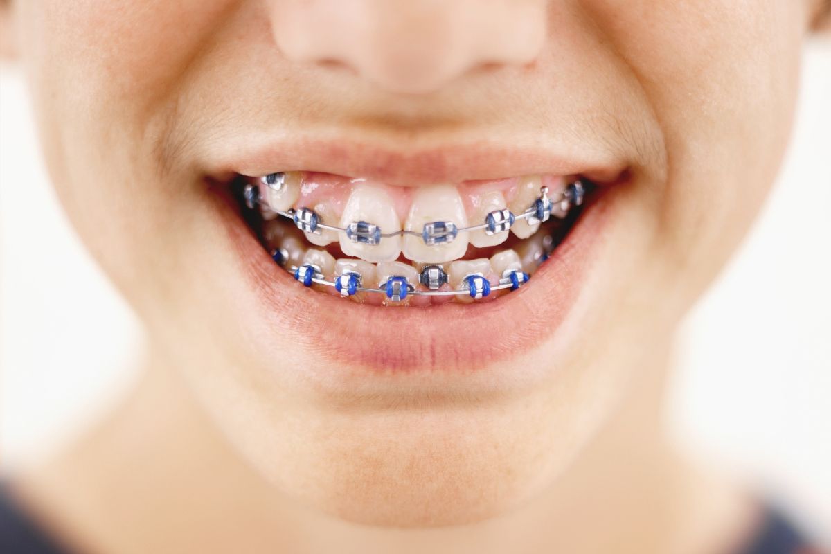 The dangers of wearing DIY braces