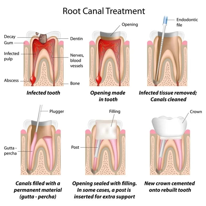 root-canal-img2