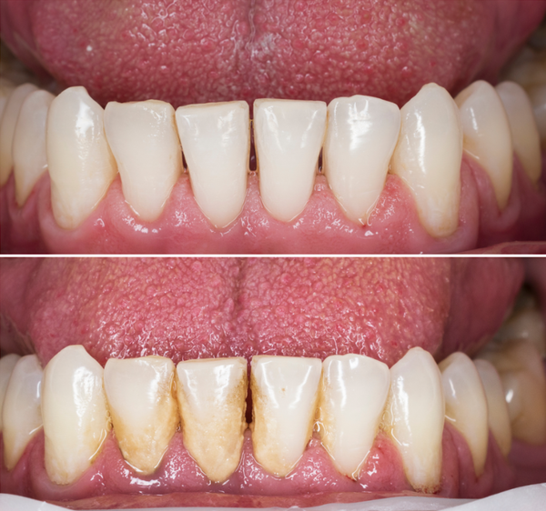 Side-by-side comparison of teeth before and after a professional cleaning.