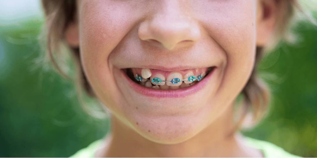 A boy wearing braces with blue and green ligatures