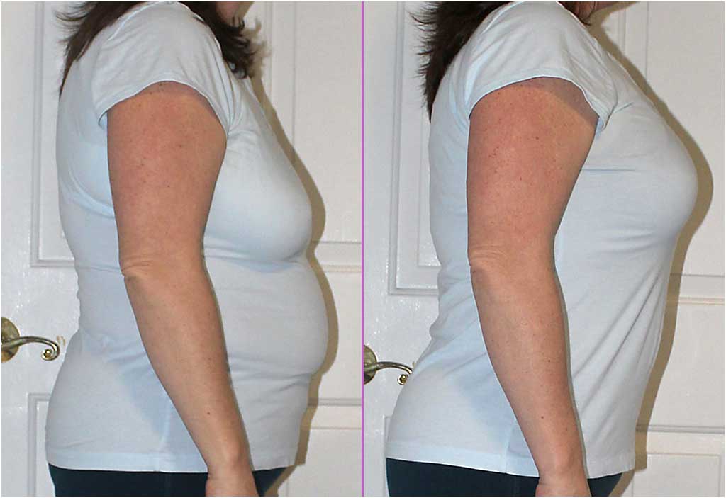 Real Life transformations in our "No Back Fat Bra" - Before & After Pictures - Shapeez