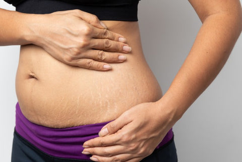 will stretch marks go away after weight loss