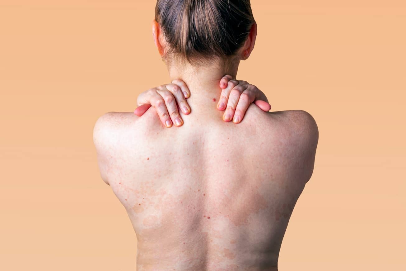 Principales alergias de la piel