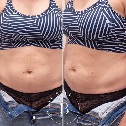 EMSCULPT before and after