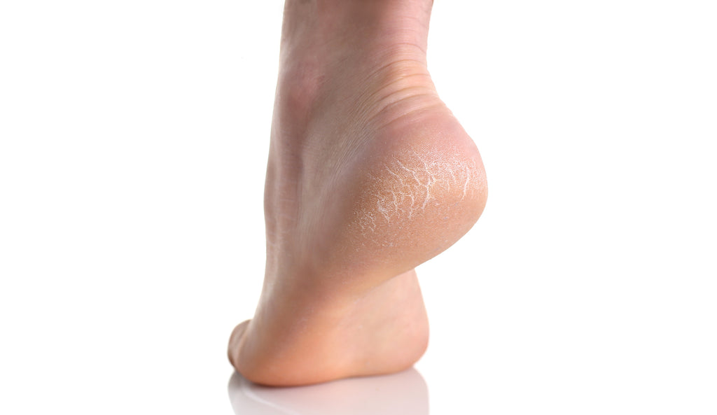 Advice for Treating Cracked & Sore Heels | Dermastore