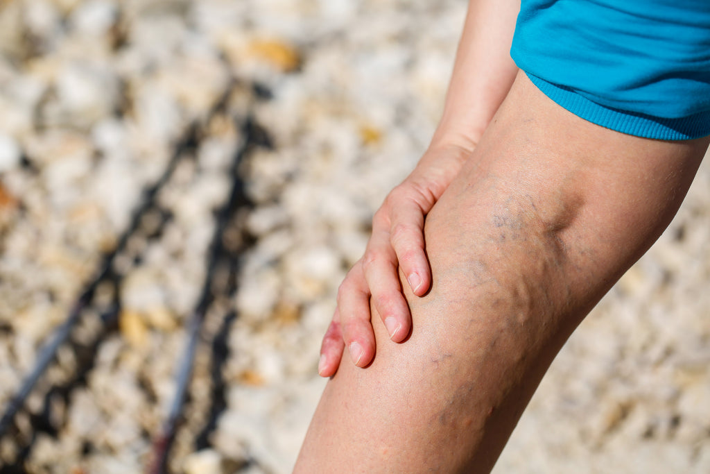 Varicose Veins Can Cause These Symptoms