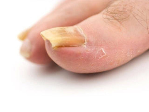 advanced nail fungus