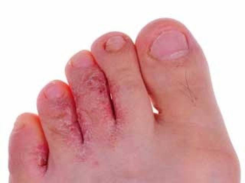 image of athletes foot