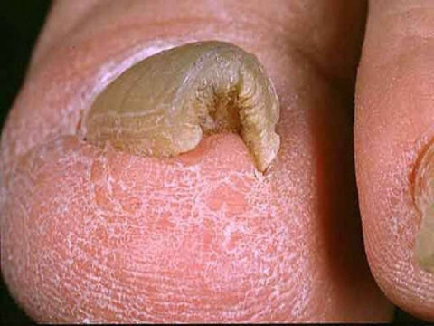 distalsubungual nail fungus infection