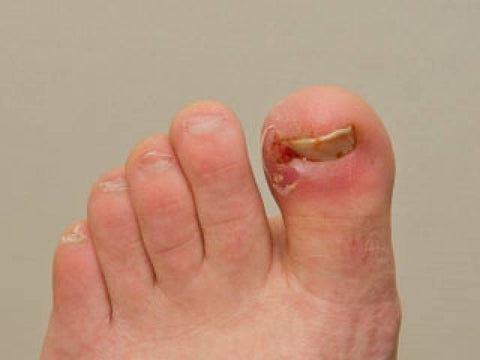 nail fungus ingrown toenail
