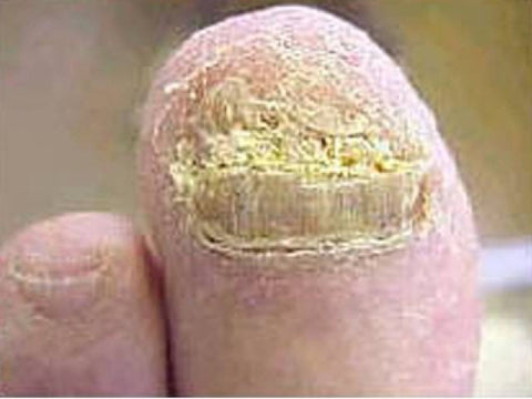 advanced toenail fungus