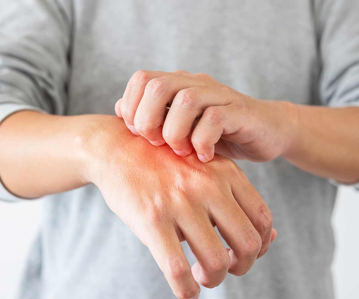 démangeaisons eczema plaques rouges