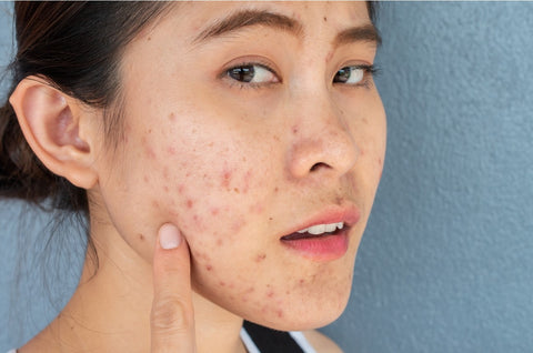 retentional acne