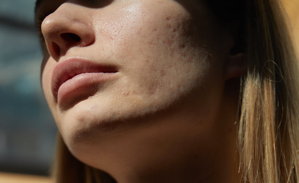 Where to begin treating persistent acne