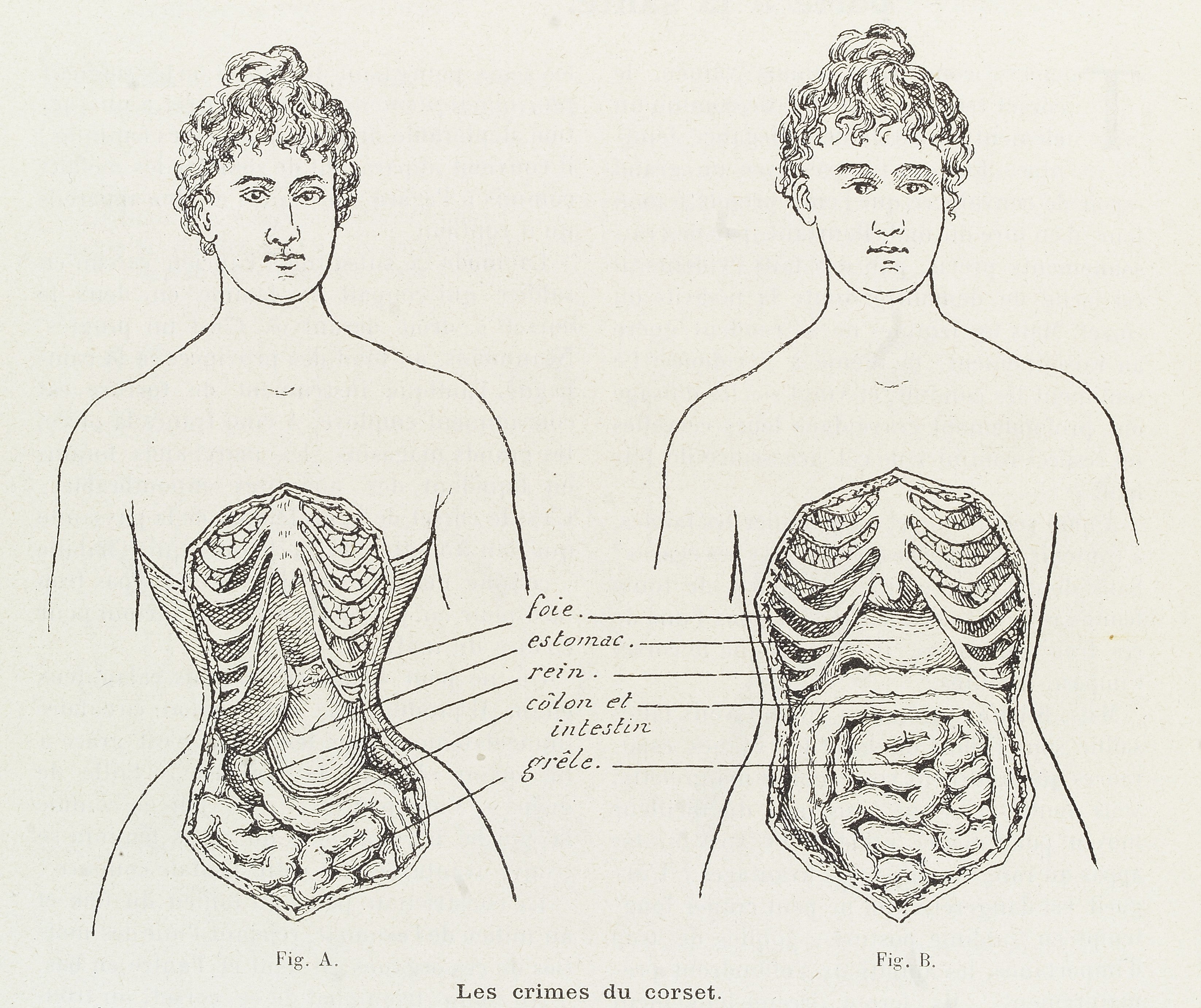 Vintage image of the effects of corsets