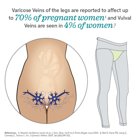 Varicose veins on a female senior legs. The stages of varicose
