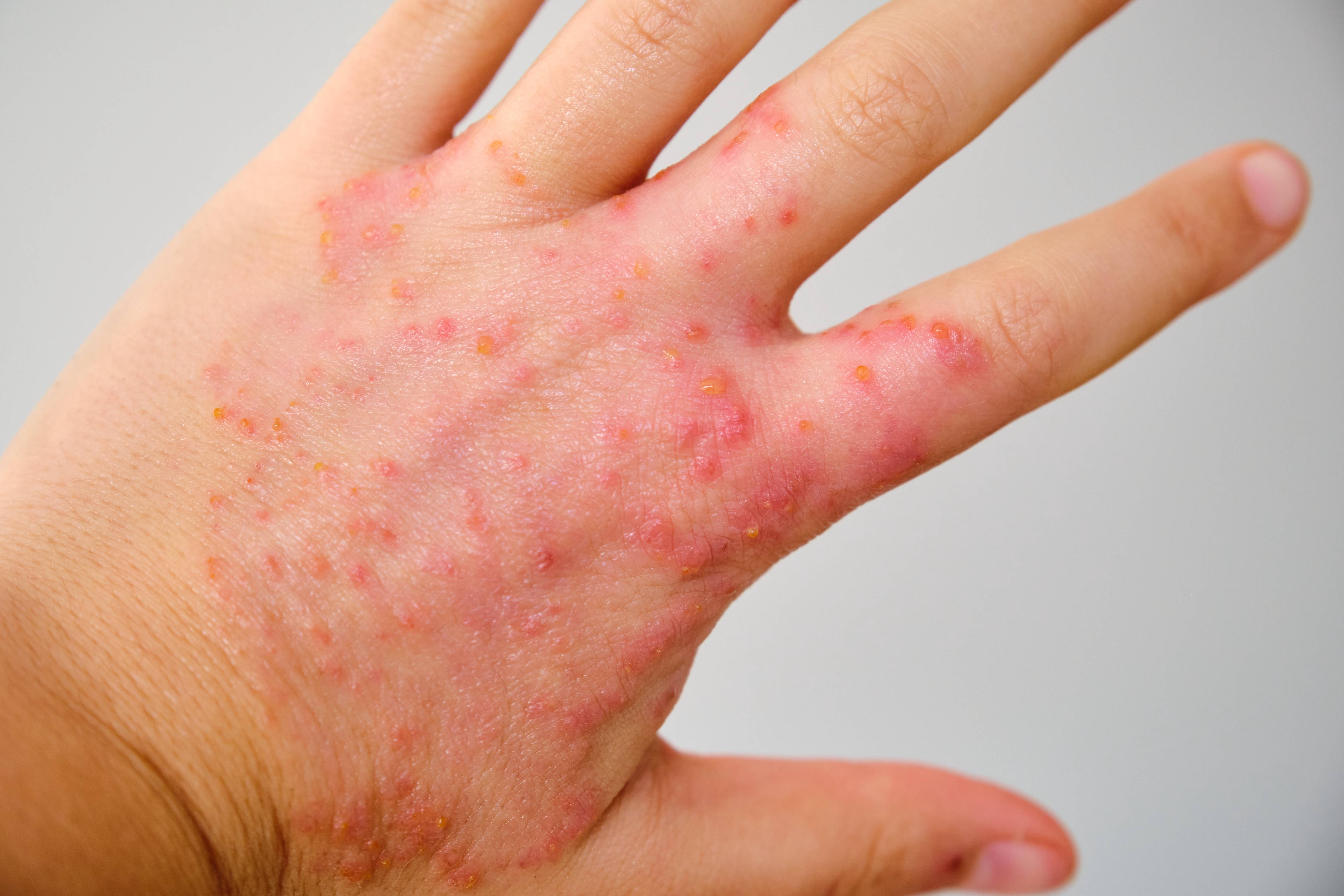 close-up-of-a-hand-with-eczema-atopic-dermatitis-2023-12-19-18-17-00-utc (1).jpg__PID:cc948a6a-7d68-4429-8265-f923f672ea27