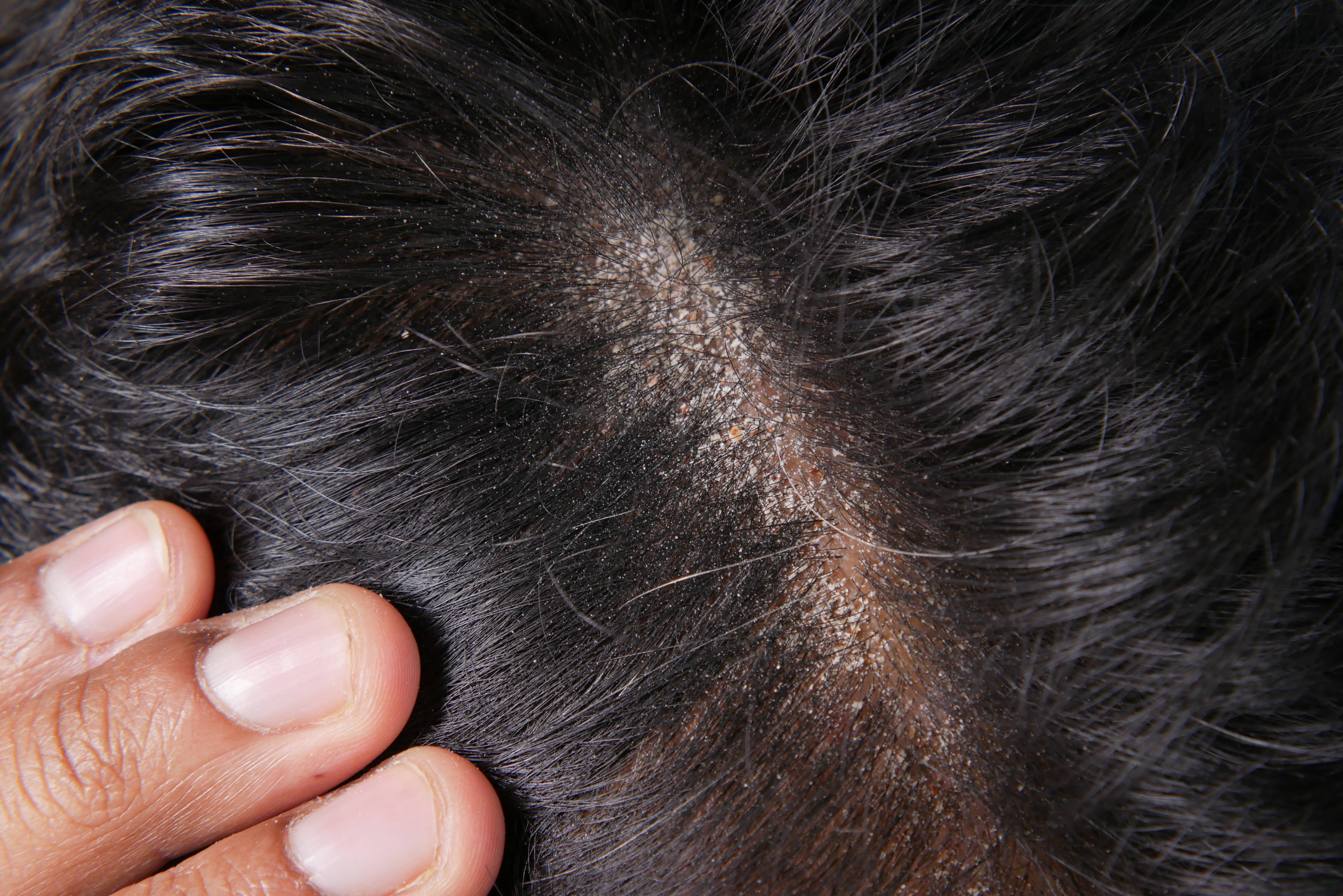 men-with-dandruff-in-his-hair-closeup-2023-11-27-05-33-51-utc (1).jpg__PID:d7d95cd0-e234-4d44-8e9d-744f93d3a343