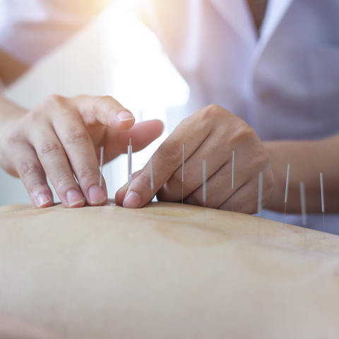 acupuncture therapy for pain relief