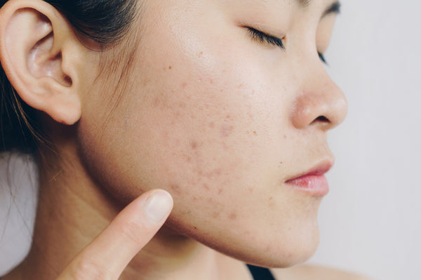 How to Get Rid of Acne Scars & Fade – Dr. Zenovia